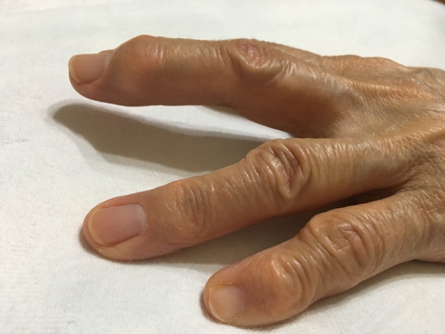 ヘバーデン結節