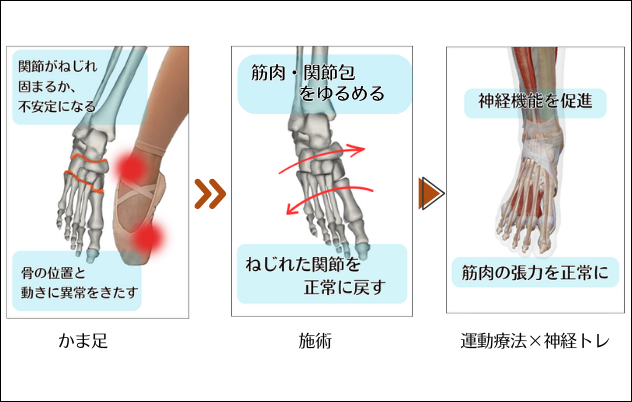 バレエのかま足